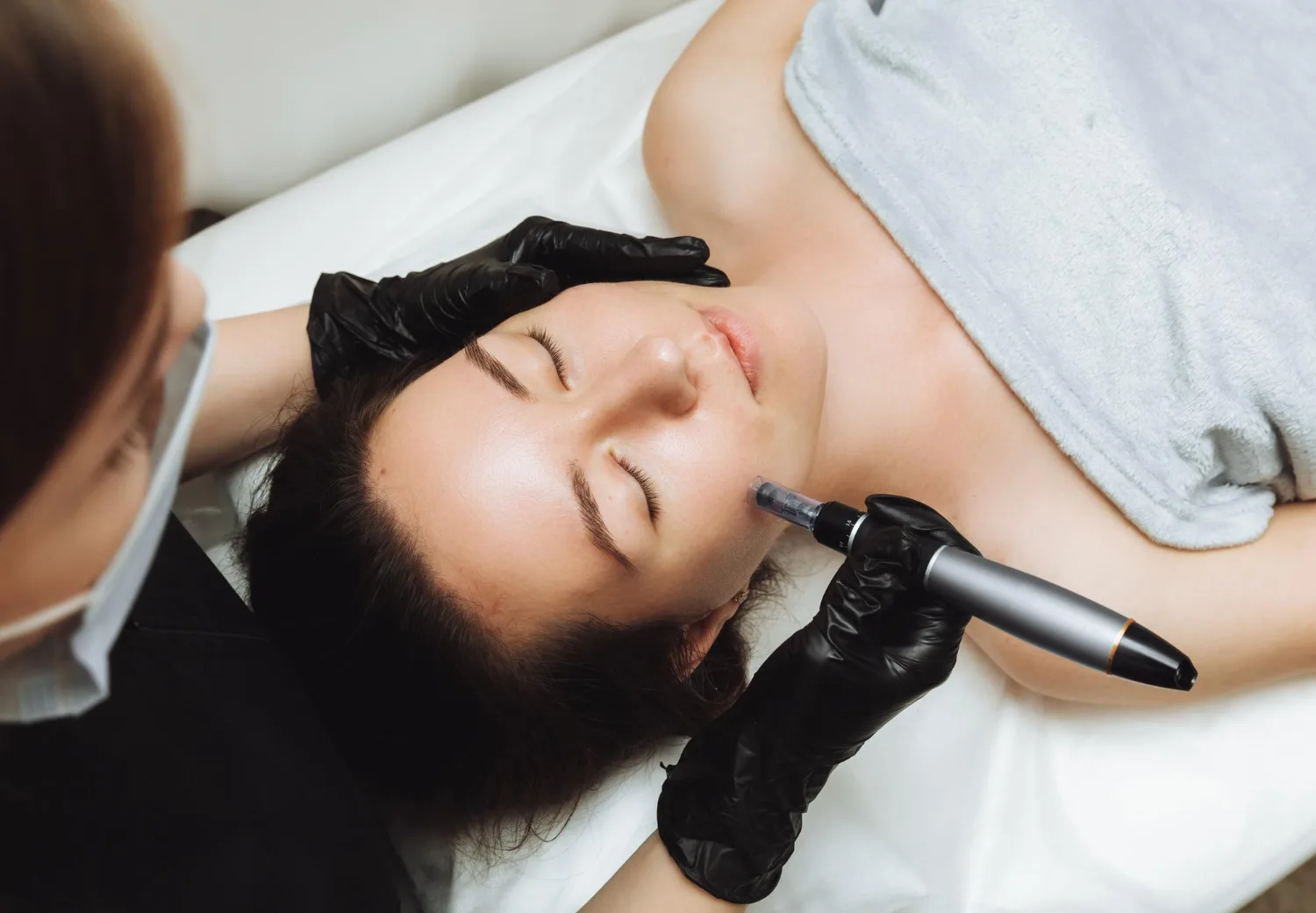 Microneedling